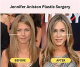 Jennifer Aniston After Plastic Surgery