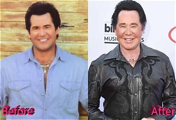 Wayne Newton Plastic Surgery, Know Everything About Wayne Newton.